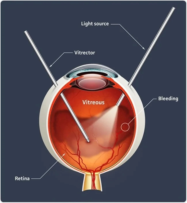 vitrectomy image