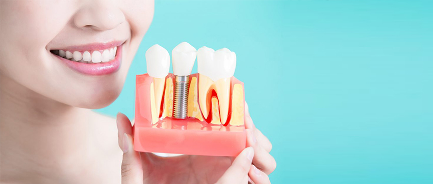 Dental implants in Markham
